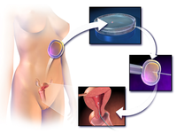 Subprogramul Național de Fertilizare in vitro şi embriotransfer